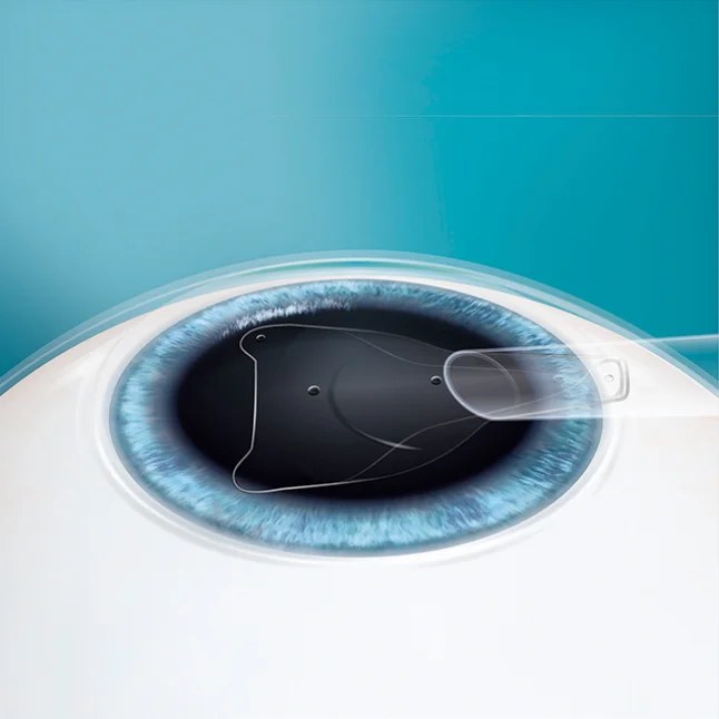 眼内コンタクトレンズの挿入